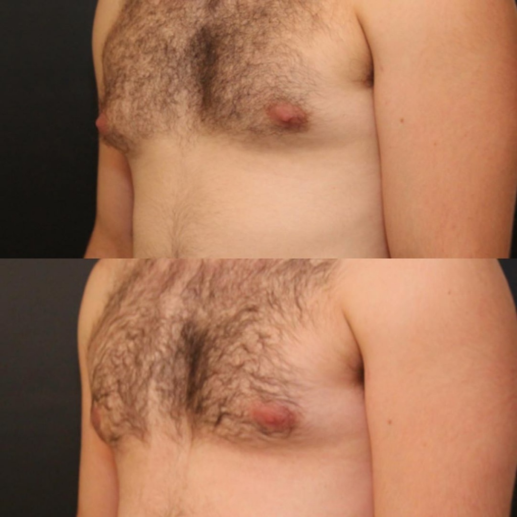 удаление желез в груди у мужчин фото 59